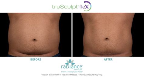 trusculpt flex avon|TruSculpt Flex .